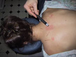 Moxibustion of Greensboro Acupuncturist Ning Li